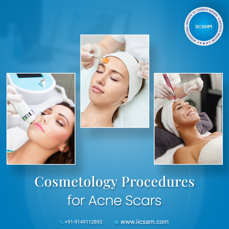 Learn Best Cosmetic Treatments to Get Rid of Acne Scars